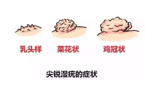 微信截圖_20230916145945 成都尖銳濕疣醫院