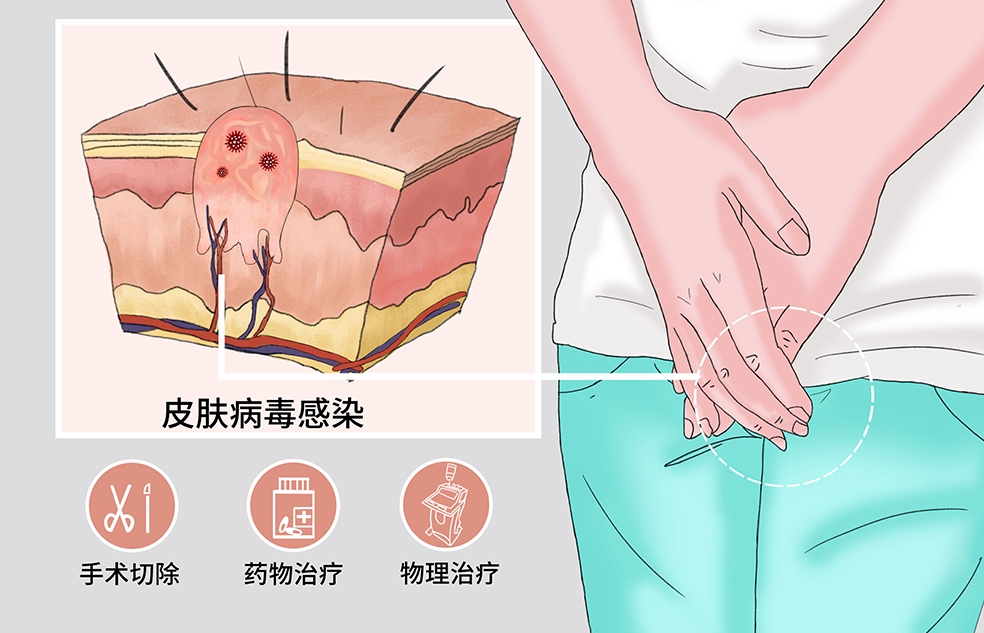 微信截圖_20231007100757 成都尖銳濕疣醫院